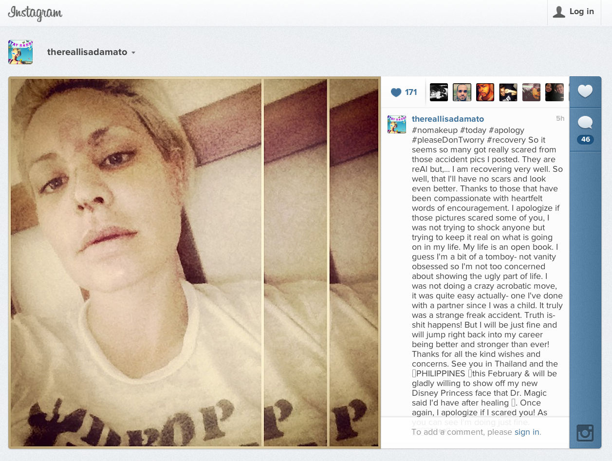 Screen Shot 2013 01 24 at 4.57.13 PM Americas Top Model Winner Disfigured Face In Freak Accident 