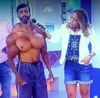 before and after muscle implants synthol 6