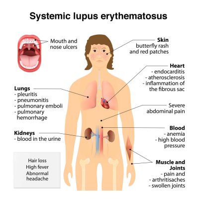 toni-braxton-lupus-symptoms