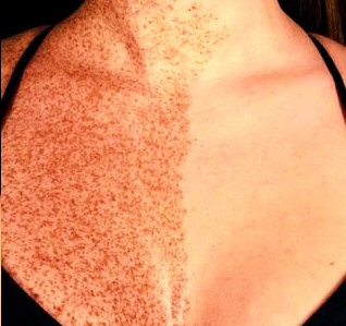 woman freckles half of body