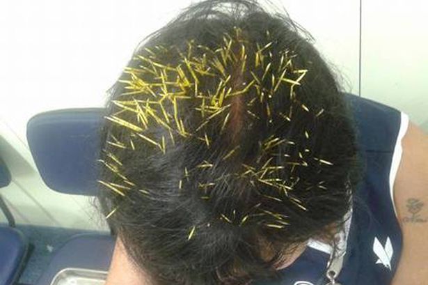 Sandra-Nabucco-who-had-a-porcupine-fall-on-her-head-whilst-walking-her-dog-in-Rio-Brazil-3032390