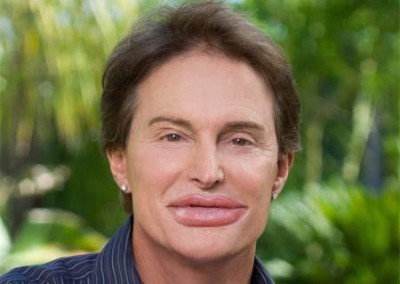 bruce jenner lip injections 5