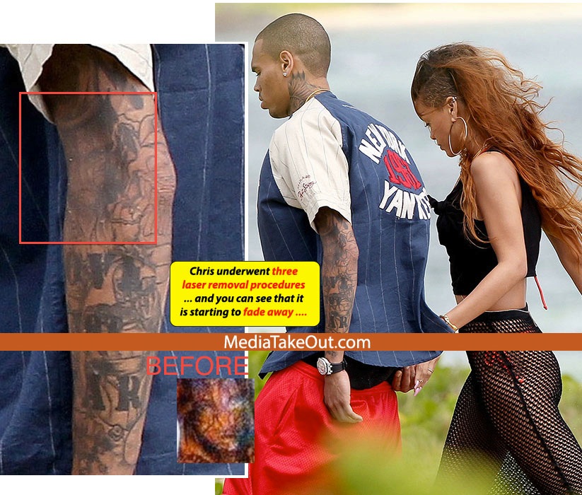 chris brown tattoo laser removal