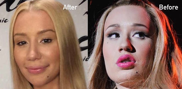 Gallery For Plastic Surgery Gone Wrong Before And After Plastic Surgery Gone Wrong Plastic Surgery Bad Plastic Surgeries