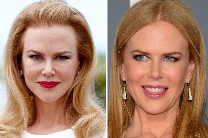 nicole kidman botox – TheCount.com