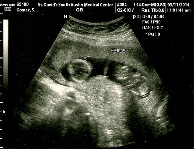 selena-gomez-ultrasound