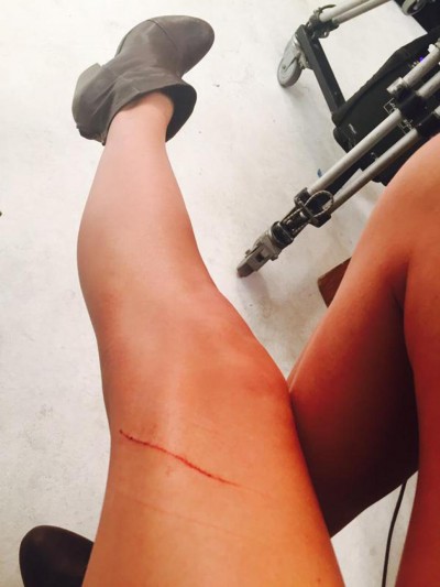 taylor swift cat scratch leg